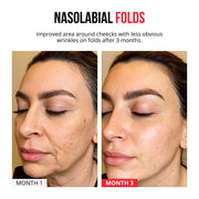 Self-dissolving Microneedle Patches