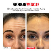 Self-dissolving Microneedle Patches