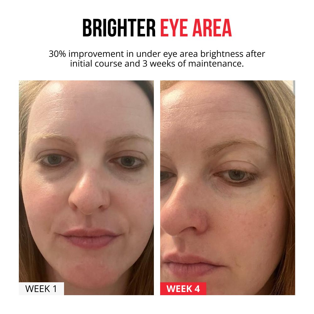 Self-dissolving Microneedle Patches