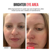 Self-dissolving Microneedle Patches